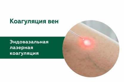 Эндовазальная лазерная коагуляция вен