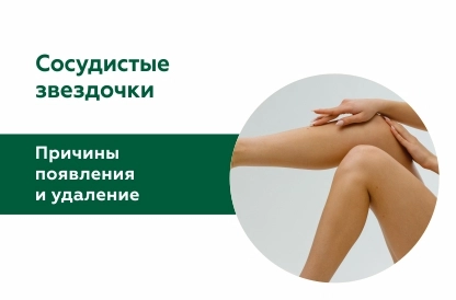 Лазерное удаление сосудистых звездочек